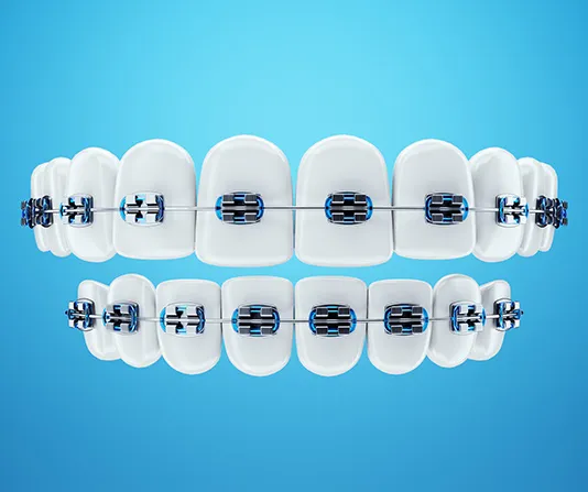 3D model of braces on rows of teeth