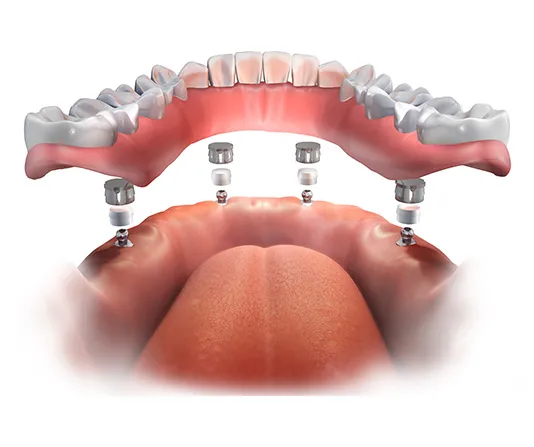 3D render of dental all on 4