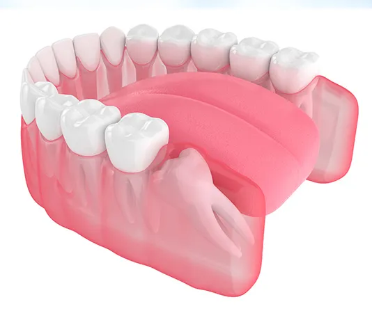 3D redering of wisdom tooth pointing horizontally against back teeth
