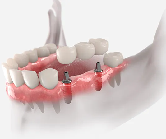 3D render dental bridge