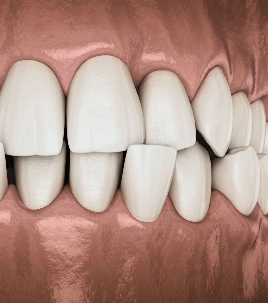 3D model of crooked teeth